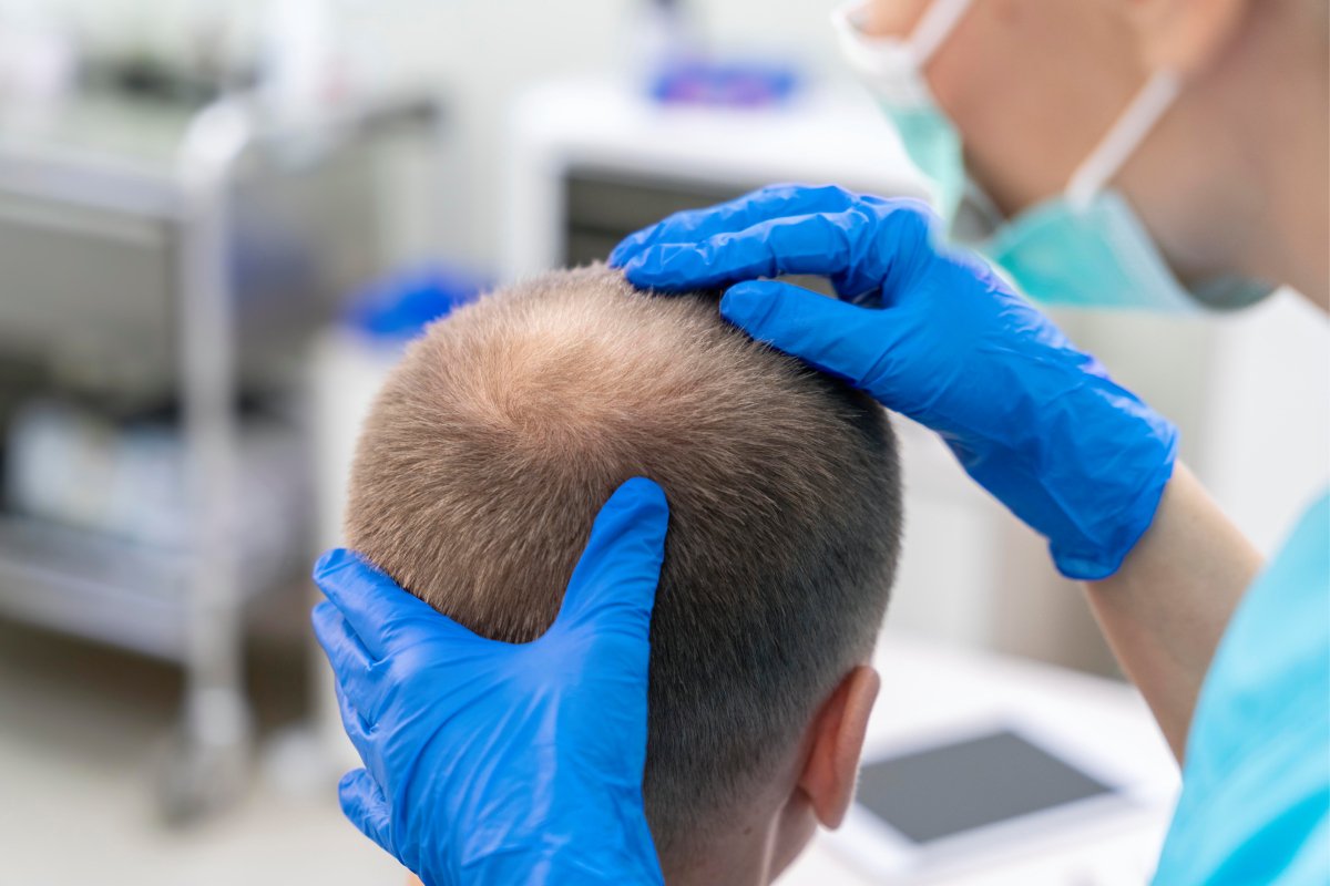 Alopecia Areata Treatment in Erode