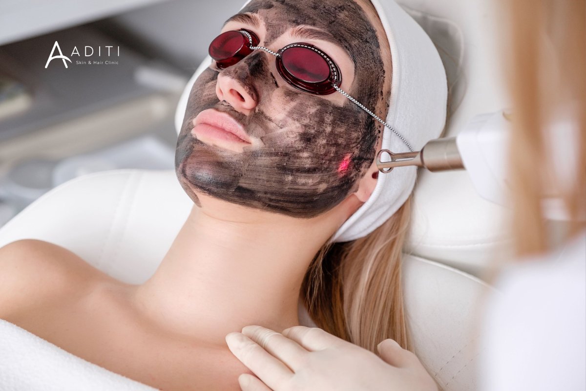 Carbon Laser Peel in Erode